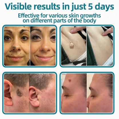 ✅🇦🇺𝐇𝐞𝒂𝒍𝗿𝗶𝙯𝙚®2-in-1 Microneedle & Hydrocolloid Patch💫| Removes Raised Moles, Acne, Flat Warts & Skin Tags | Helps Improve Wrinkles, Scars & Blemishes | Invisible Patches for Face & Body
