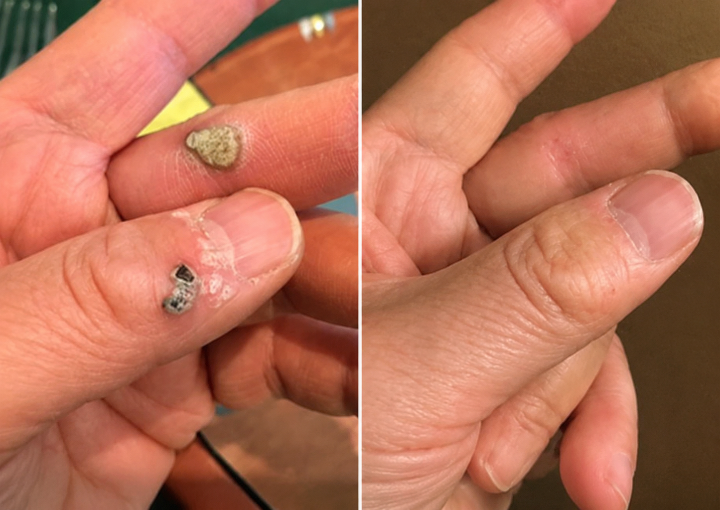 ✅🇦🇺𝐇𝐞𝒂𝒍𝗿𝗶𝙯𝙚®2-in-1 Microneedle & Hydrocolloid Patch💫| Removes Raised Moles, Acne, Flat Warts & Skin Tags | Helps Improve Wrinkles, Scars & Blemishes | Invisible Patches for Face & Body