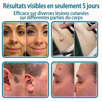 ✅🇫🇷 **Healrize® Patch 2-en-1 à micro-aiguilles & hydrocolloïde** 💫 Aide à réduire l’apparence des grains de beauté en relief, de l’acné, des verrues planes et des acrochordons | Patchs invisibles pour le visage et le corps