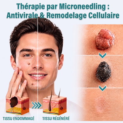 ✅🇫🇷 **Healrize® Patch 2-en-1 à micro-aiguilles & hydrocolloïde** 💫 Aide à réduire l’apparence des grains de beauté en relief, de l’acné, des verrues planes et des acrochordons | Patchs invisibles pour le visage et le corps